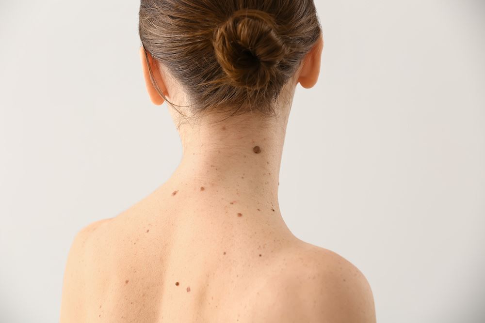 person with spots on back